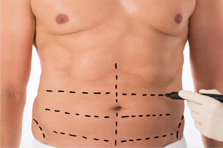 Abdominoplastia: Restaurando a Forma do Abdômen