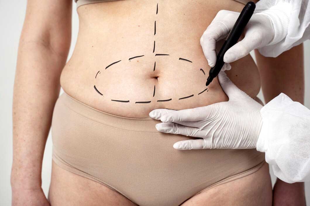 Lipoaspiração: Transformando Silhuetas