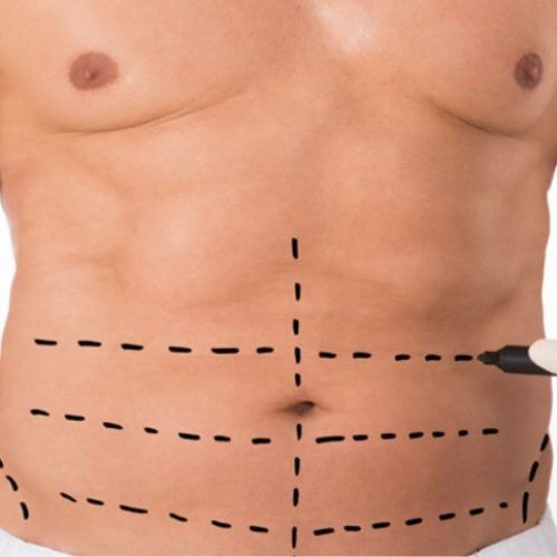 Abdominoplastia: Restaurando a Forma do Abdômen