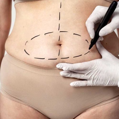 Lipoaspiração: Transformando Silhuetas