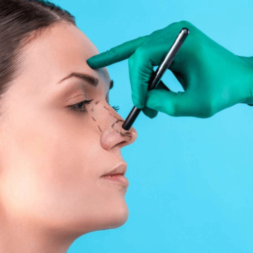 Rinoplastia: Harmonizando o Rosto