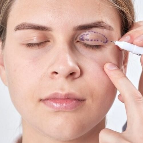 Blefaroplastia: Rejuvenescimento da Área dos Olhos